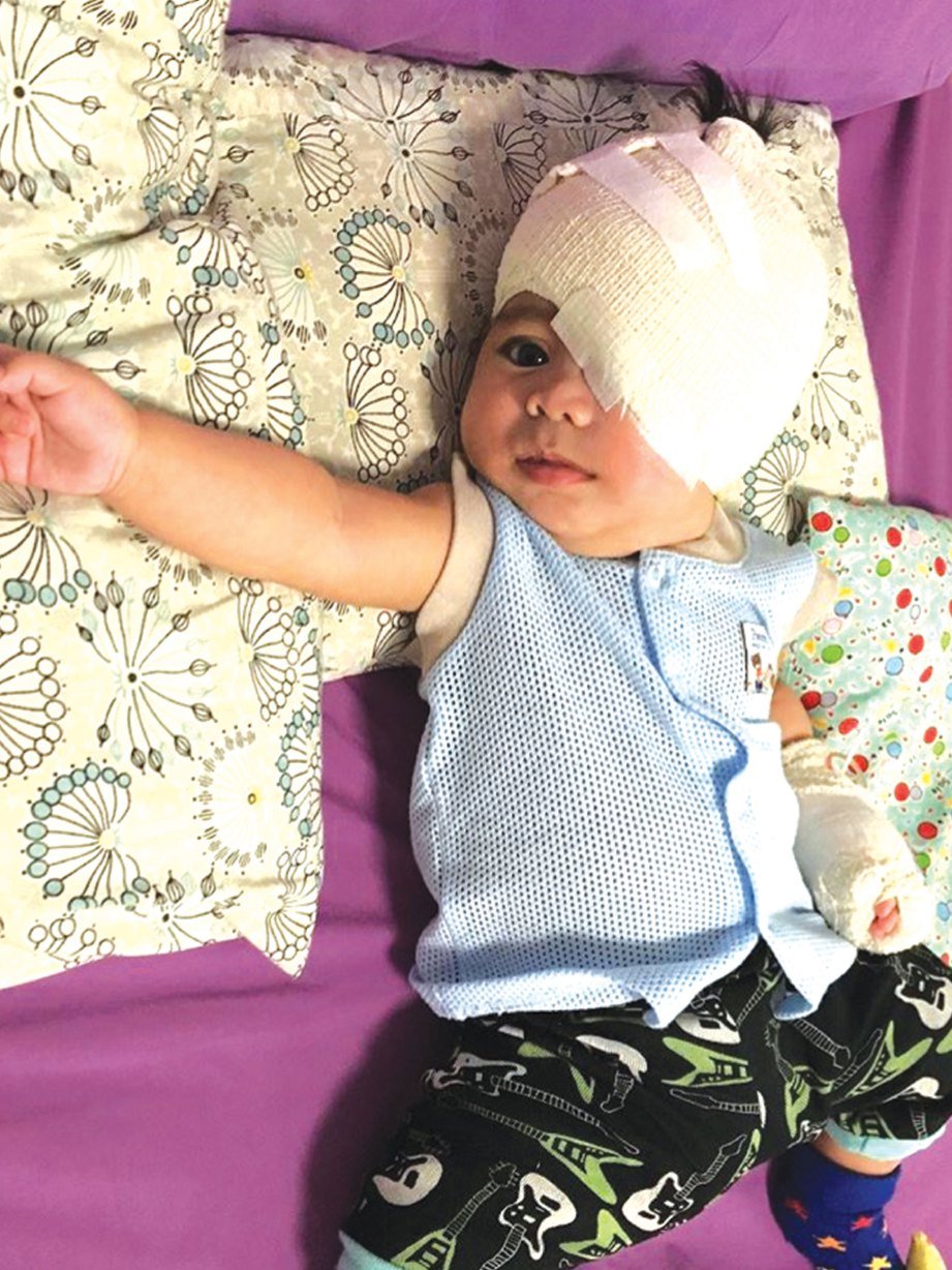 AYA Nafeesa selepas menjalani pembedahan membuang mata kirinya ketika berusia empat bulan.