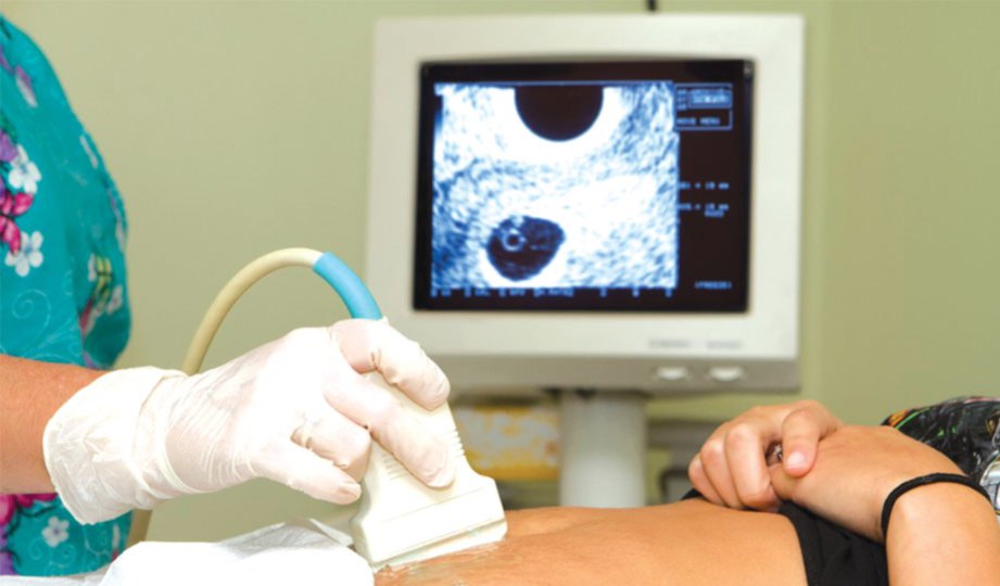 UJIAN ultrabunyi membantu untuk melihat dengan jelas lokasi dan saiz fibroid.