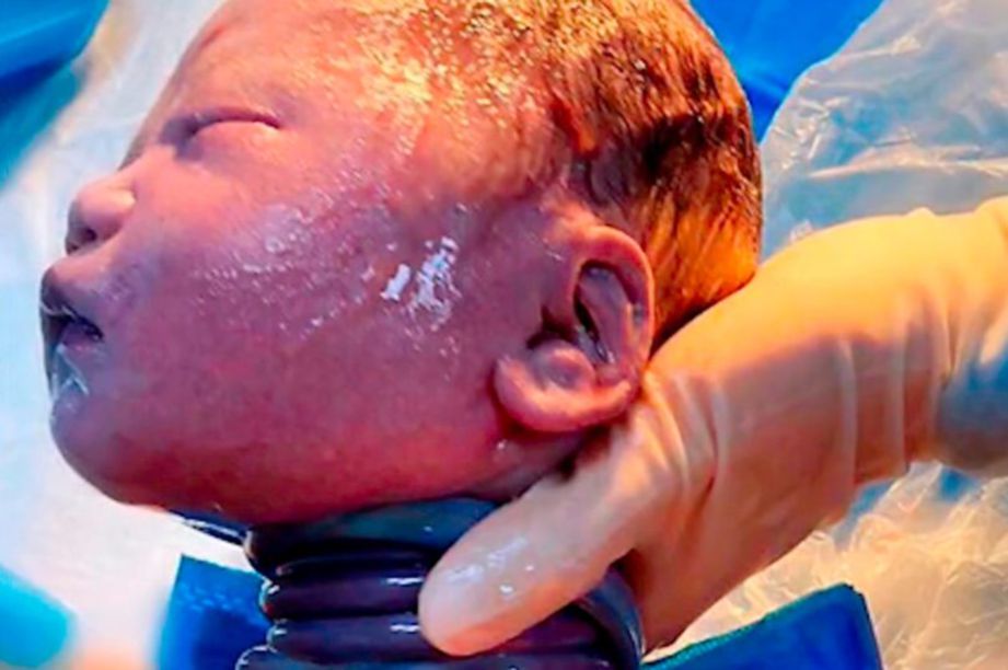 KELAHIRAN seorang bayi mengejutkan doktor yang menyambutnya apabila ditemui terbelit tali pusat di lehernya sebanyak enam kali seperti seekor ular. FOTO Agensi