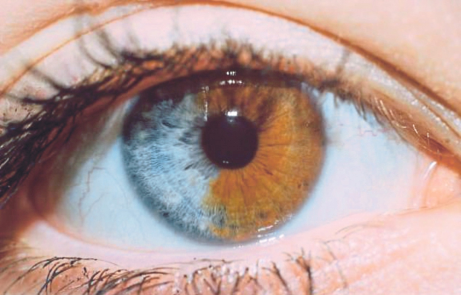 SATU mata tetapi dua warna, keadaan ini dipanggil heterochromia iridis.