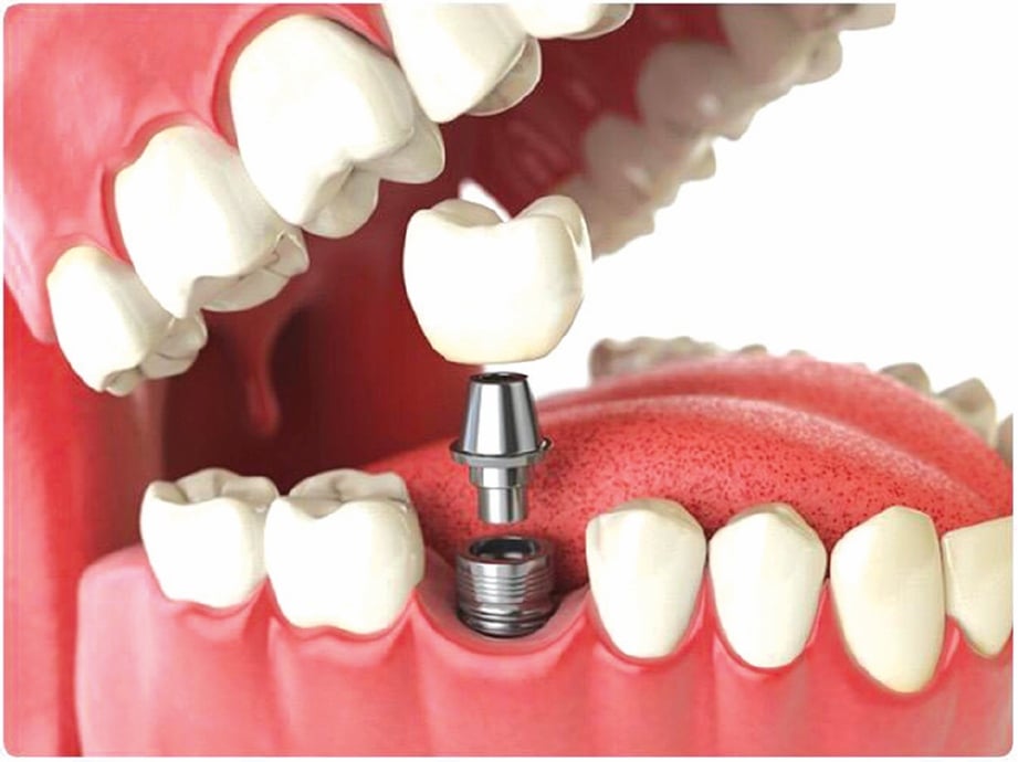 IMPLAN gigi kaedah popular ganti gigi hilang.