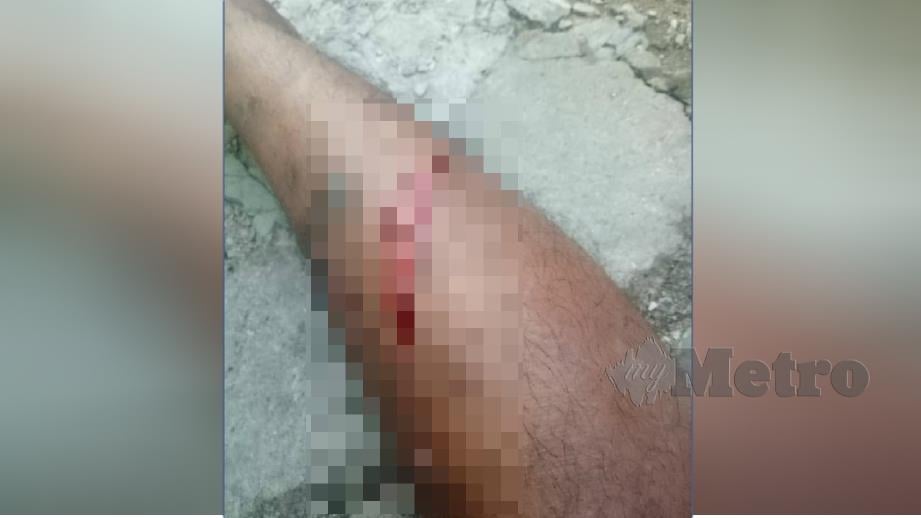 Kaki kiri mangsa yang cedera selepas seorang lelaki melibas parang kepadanya. FOTO Ihsan Pembaca 
