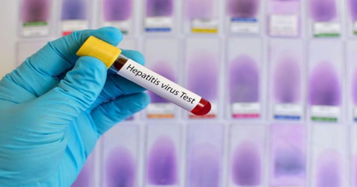 UJIAN virus hepatitis dilakukan untuk mengenal pasti jangkitan. 