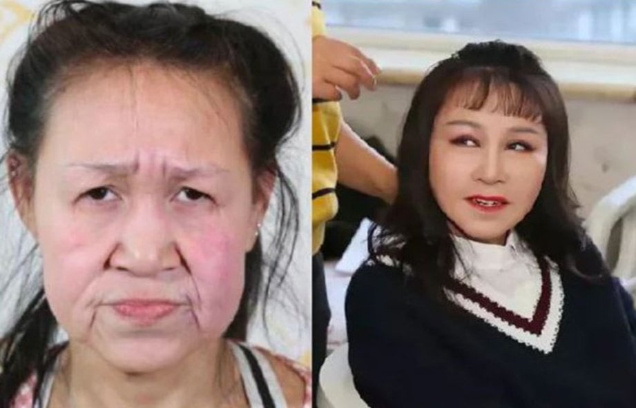 XIAOFENG (kiri) kelihatan tua dan (kanan) wajah muda selepas pembedahan. FOTO Agensi 