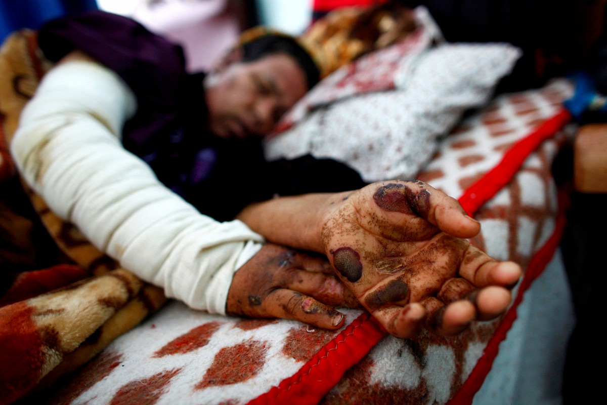 Gambar fail menunjukkan mangsa yang cedera akibat terkena bom yang mengandungi fosforus putih. - FOTO Reuters