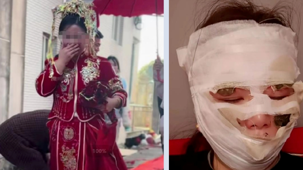 KEADAAN muka pengantin wanita selepas terkena penyembur gas FOTO thepaper.cn