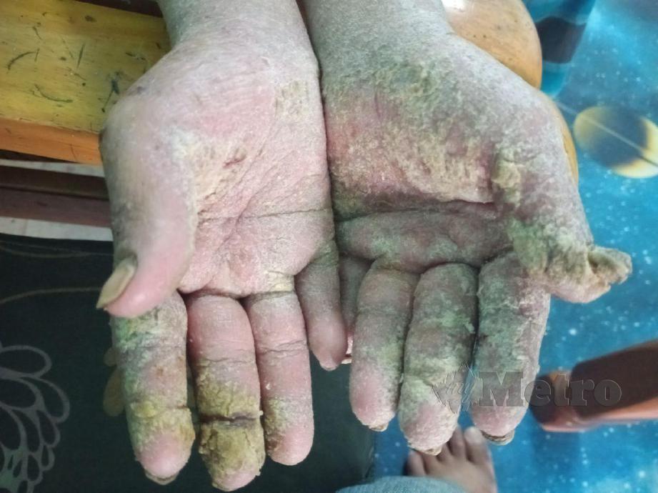 KEADAAN tangan Nurjannah Shaiful, yang menghidap penyakit ‘eczema’ yang menyebabkan kegatalan dan berkudis sejak tiga tahun lalu. FOTO Mohd Khidir Zakaria