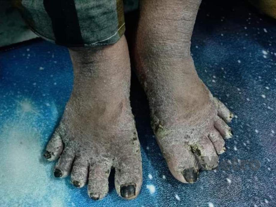 KEADAAN kaki Nurjannah Shaiful, yang menghidap penyakit ‘eczema’ yang menyebabkan kegatalan dan berkudis sejak tiga tahun lalu. FOTO Mohd Khidir Zakaria