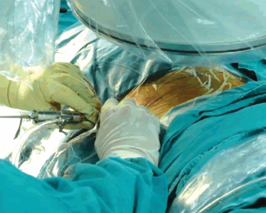 RAWATAN pembedahan diskektom endoskopi ke atas pesakit.  - FOTO Google