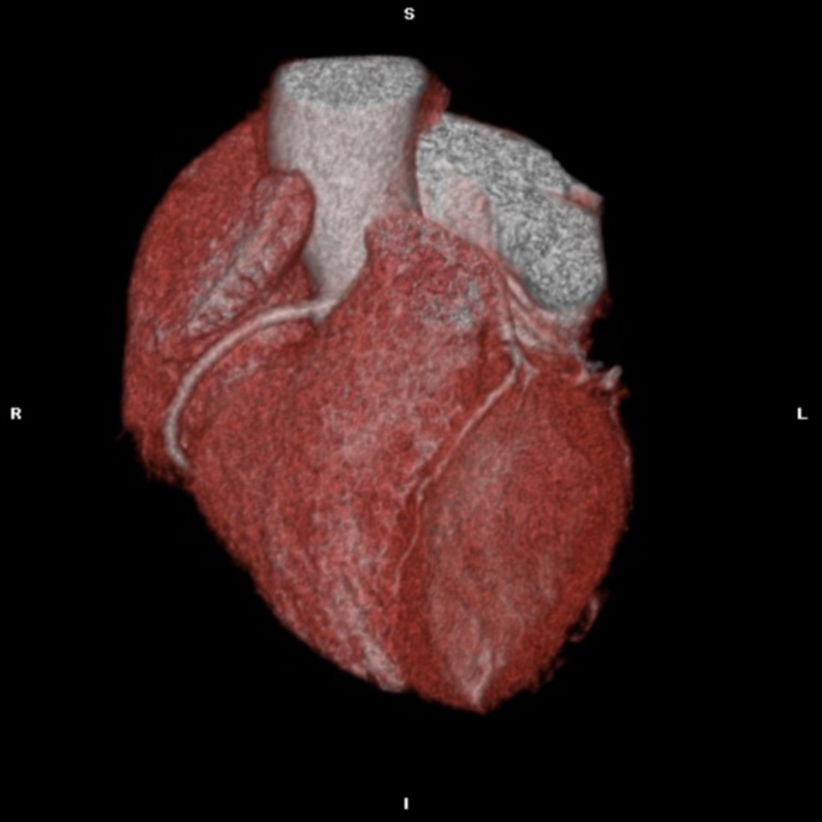 GAMBAR jantung imbasan computed tomography (CT). 