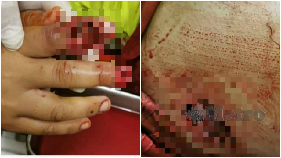 Kesan luka di paha dan tangan mangsa selepas suaminya secara tidak sengaja tertarik picu senapang buatan sendiri di di Kampung Baba, Telupid di Beluran semalam. Foto Juwan Riduan 