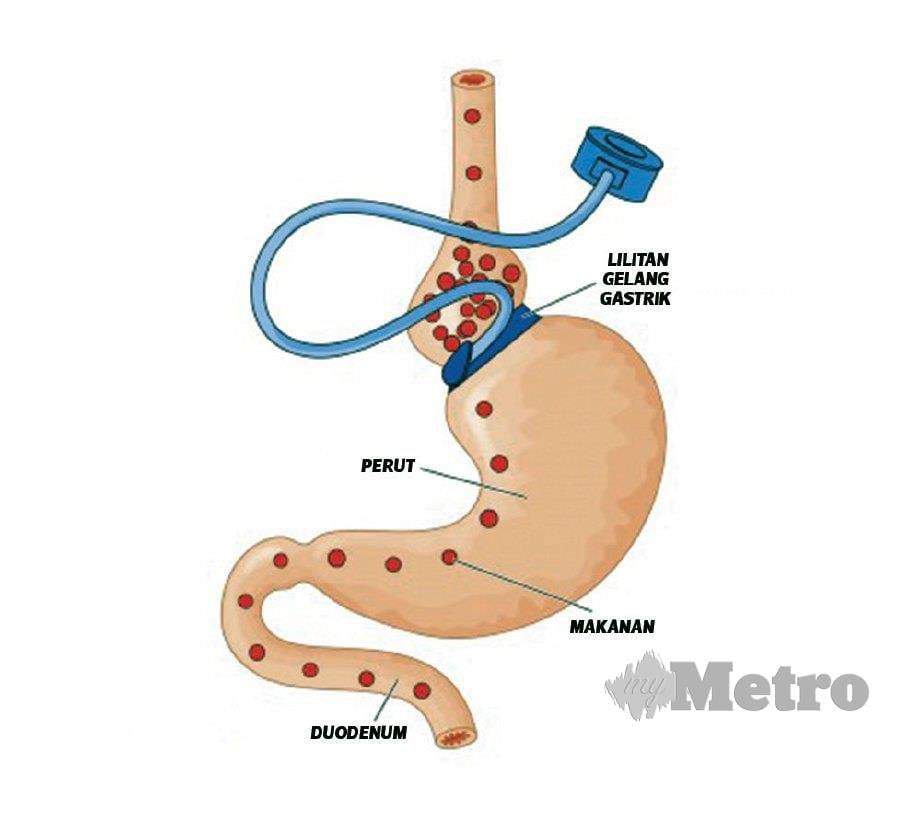 SILIKON berbentuk cincin yang diikat pada bahagian saluran atas usus yang juga laluan makanan masuk ke dalam perut bagi pembedahan ‘gastric banding’.