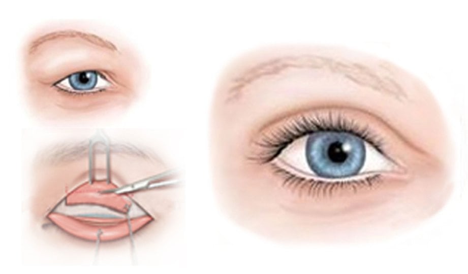 PEMBEDAHAN ‘suspensi otot depan mata’ bagi pemasangan tendon diambil daripada bahagian tubuh lain kepada mata.