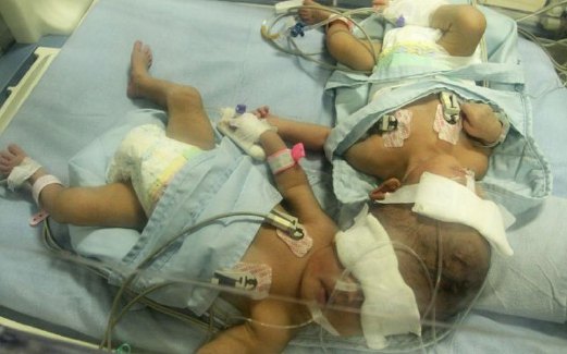 KEADAAN bayi kembar siam yang dirawat di sebuah hospital di Aceh.