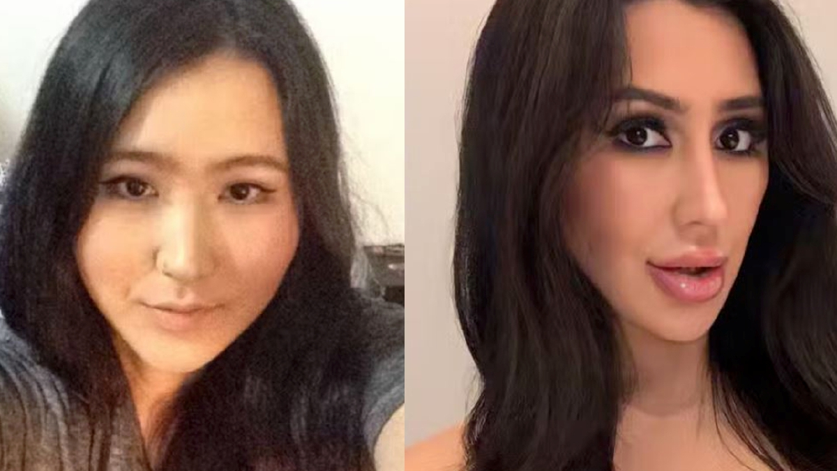 PERBEZAAN wajah Lee sebelum (kiri) dan selepas (kanan) menjalani pembedahan berkenaan. 