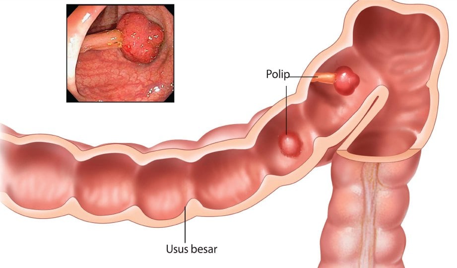 POLIP dalam usus besar sebelum melarat menjadi kanser.