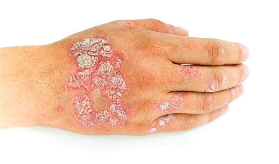 KEADAAN kulit tangan penghidap psoriasis. FOTO Google