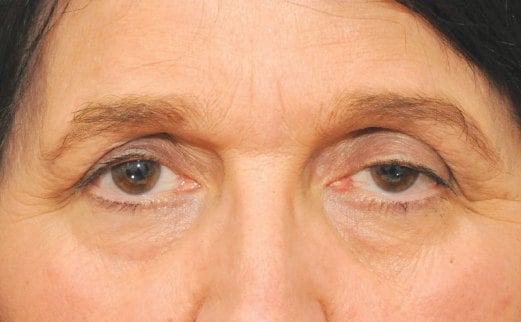 SEIRING usia, otot di kelopak mata menjadi lemah.