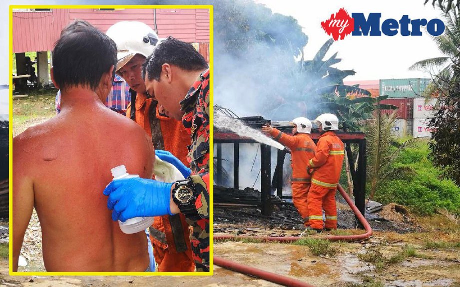 Antara kesan melecur di badan Shari selepas menyelamatkan anaknya dalam kejadian kebakaran di Kampung Rancha-Rancha, Labuan, hari ini. FOTO ihsan bomba