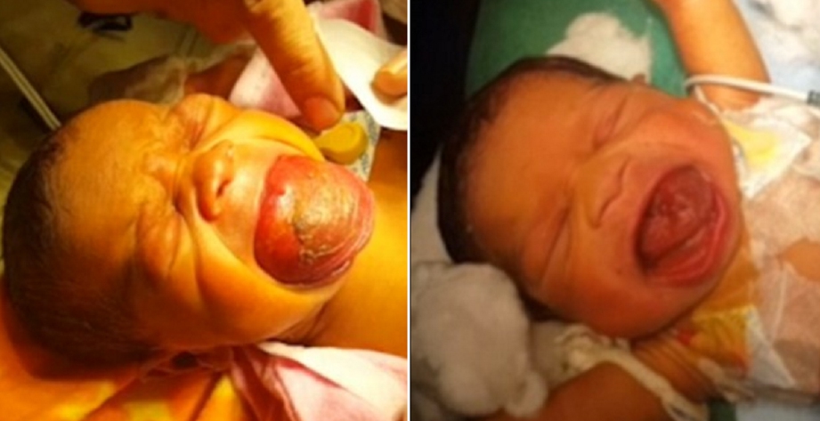 keadaan Lidah bayi berusia empat hari sebelum (kiri) dan selepas pembedahan (kanan). - Foto Daily Mail