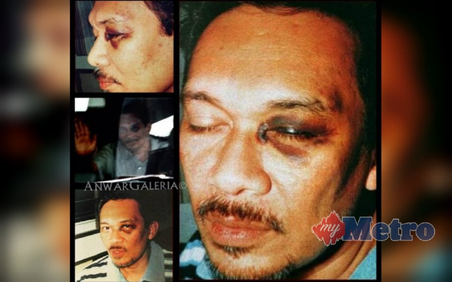 Gambar mata lebam Anwar selepas dipukul pada 21 September 1998. FOTO Ihsan Twitter Galeri Anwar Ibrahim