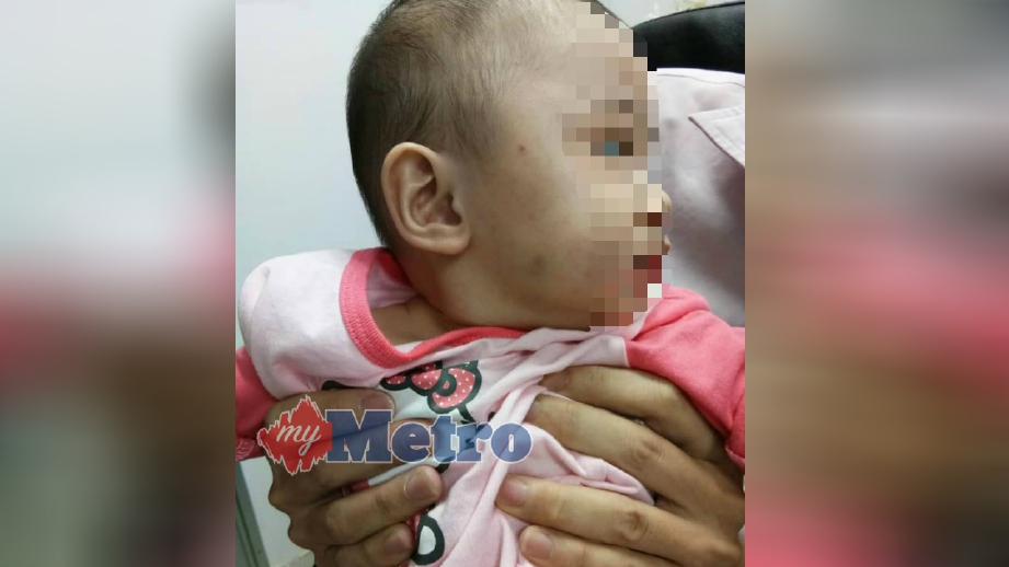 BAYI perempuan berusia 10 bulan dimasukkan ke HSB, ALor Setar selepas kedua-dua belah pipinya lebam dipercayai akibat didera pengasuh yang dikenali ibunya melalui aplikasi WeChat, semalam. FOTO Zuliaty Zulkiffli.
