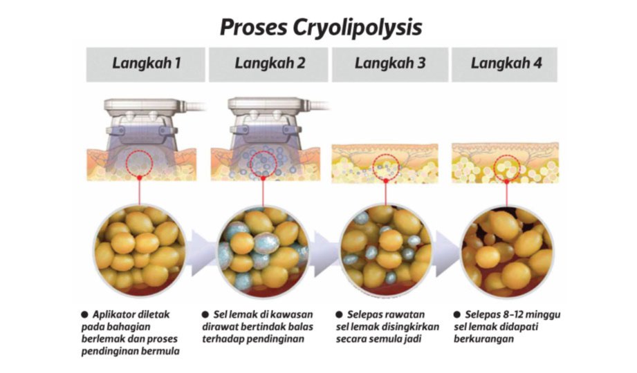 PROSES Cryolipolysis.