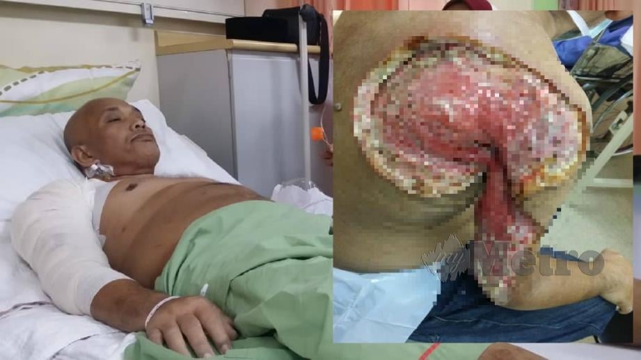 MOHD Razin ketika menerima rawatan di Hospital Sungai Buloh. (Gambar kecil) Keadaan kulit belakang selepas dibuang akibat jangkitan. FOTO IHSAN MOHD RAZIN MOHAMED