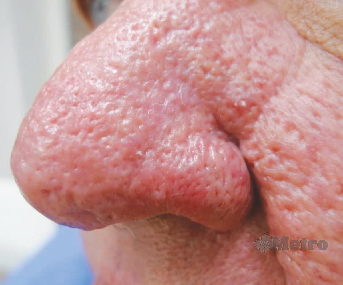RHINOPHYMA menyebabkan kulit hidung menjadi tebal.