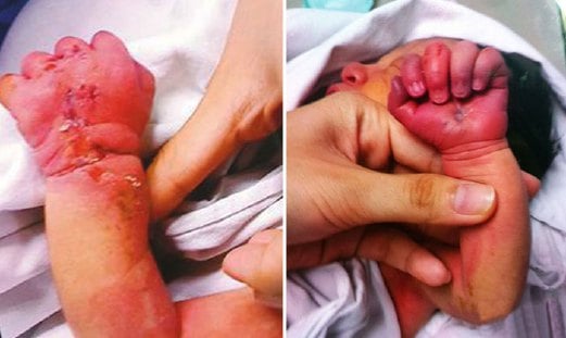 KESAN gigitan pada tangan bayi itu selepas digigit ibunya.
