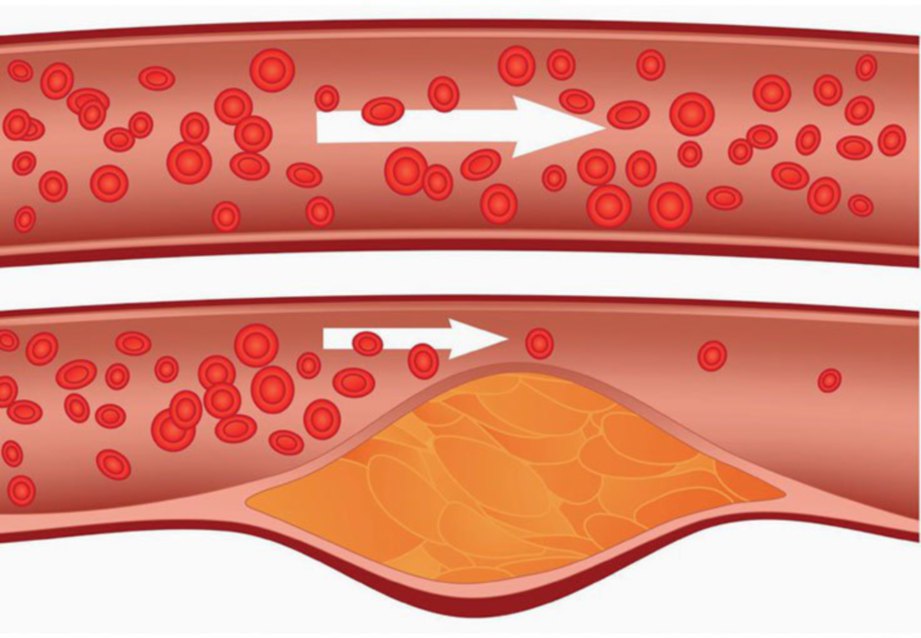 PERBANDINGAN saluran darah normal (atas) dan tersumbat dengan lemak terkumpul.