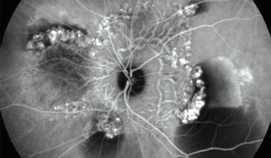 PERTUMBUHAN polip pada saluran darah tidak normal dalam retina.