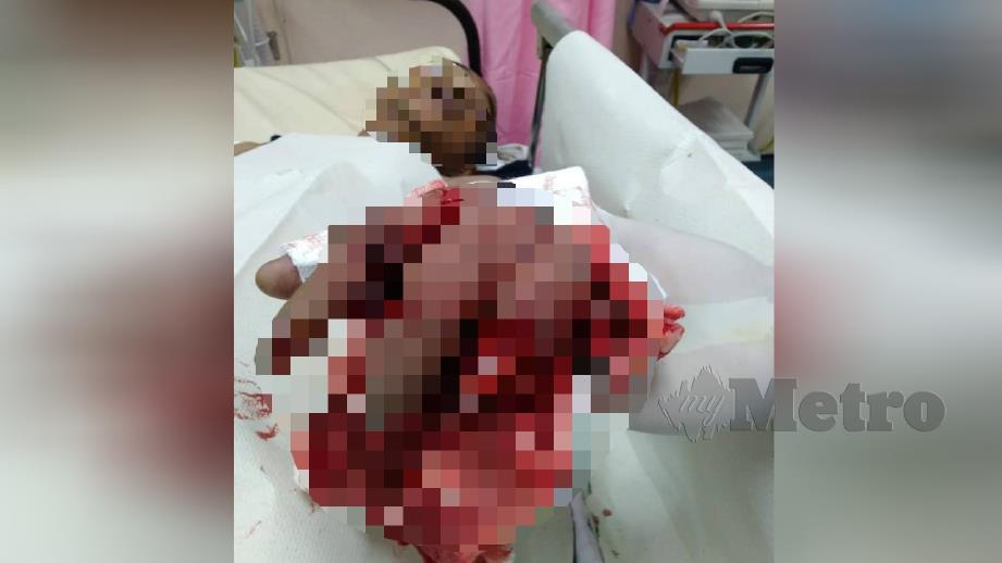LELAKI dirawat di Hospital Sultan Abdul Halim (HSAH) Sungai Petani selepas tangan kirinya parah ketika bermain mercun bola di Kampung Changhai, Sik, semalam. FOTO ihsan pembaca.
