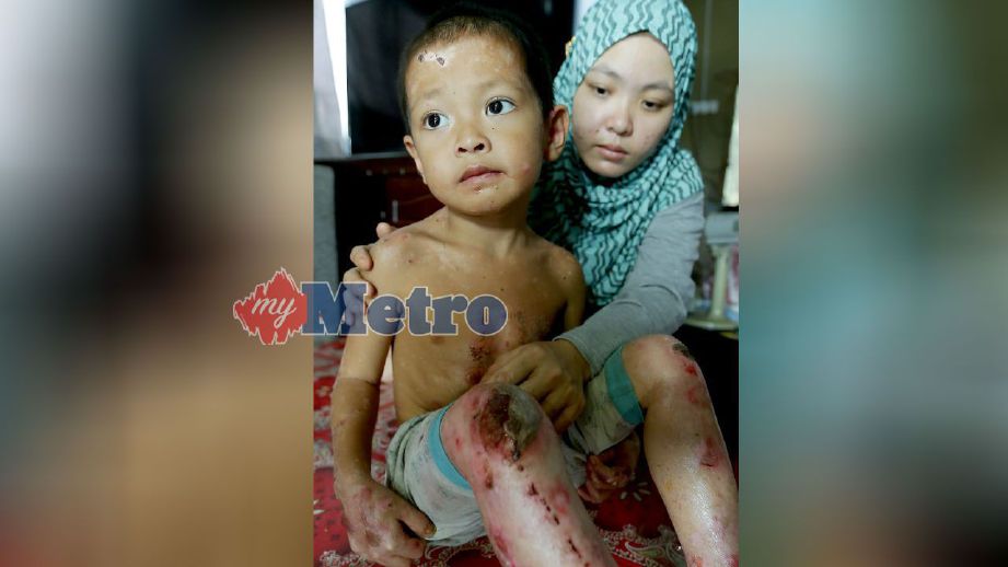 Siti Nurarfa menunjukkan luka pada badan Aminrudin yang disahkan menghidap penyakit kekurangan enzim dalam sel darah merah sejak lahir. FOTO Fathil Asri