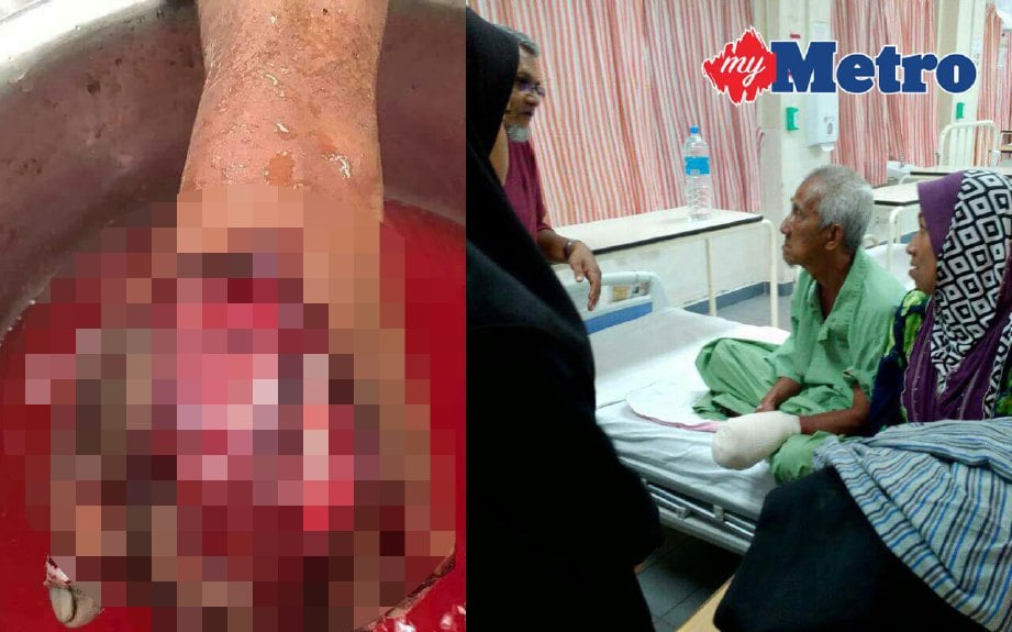 Pergelangan tangan dan jari kiri Abdul Majid tersepit pada mesin tebu, semalam dan keadaannya kini stabil selepas menjalani pembedahan. FOTO ihsan pembaca 