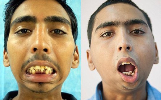 GAMBAR sebelum (kiri) dan selepas Sharma menjalani pembedahan.