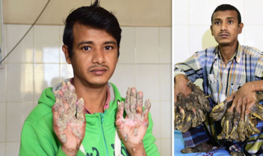 BAJANDAR terpaksa kembali ke hospital selepas keadaan ketumbuhan pada tangannya semakin teruk. FOTO Agensi