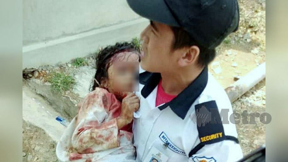 MURID Perempuan Tahun Satu SK Lipasu parah selepas diserang seekor anjing pada Jumaat lalu. FOTO ihsan pembaca