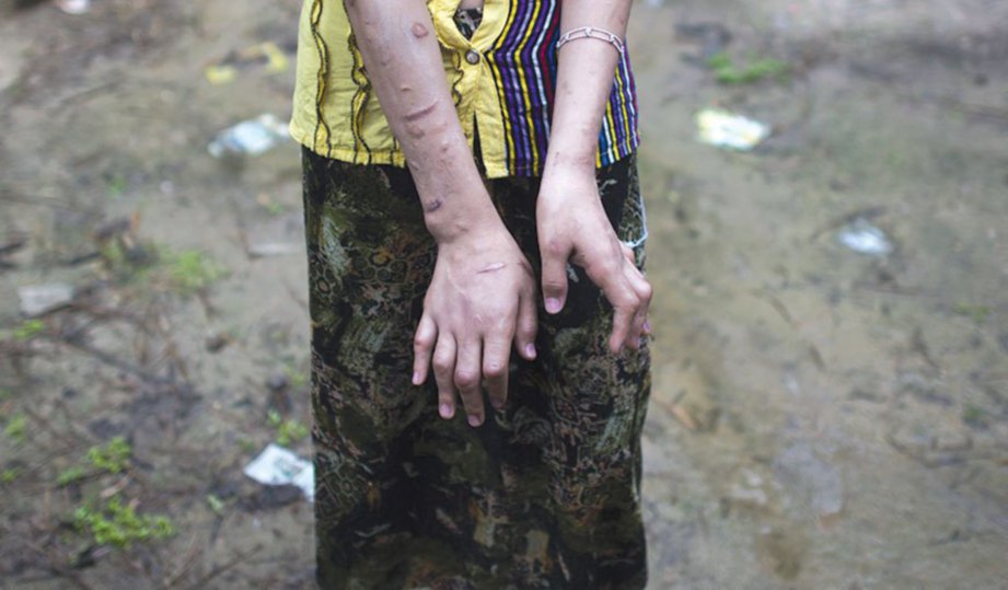 KESAN parut dan kecacatan jari menjadi bukti penderitaan yang dilalui Kay Khine.