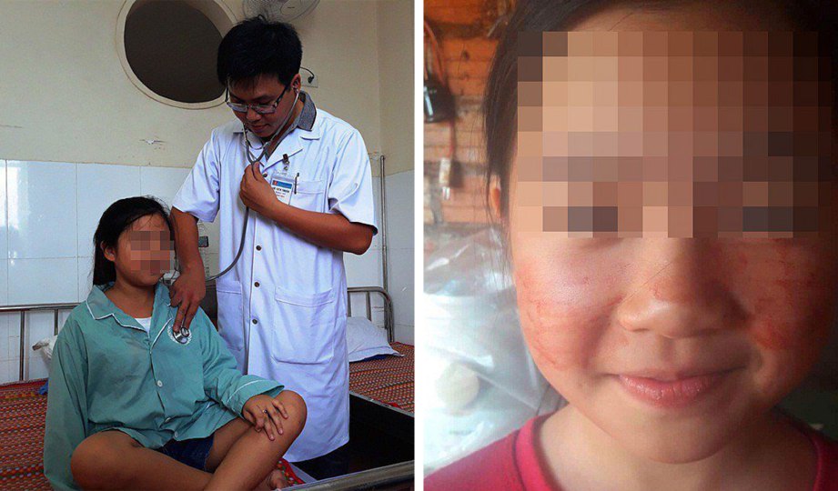DOKTOR membuat pemeriksaan kesihatan pada kanak-kanak itu. Gambar kanan, darah seperti peluh yang keluar dari muka. FOTO Vietgiatri.vn