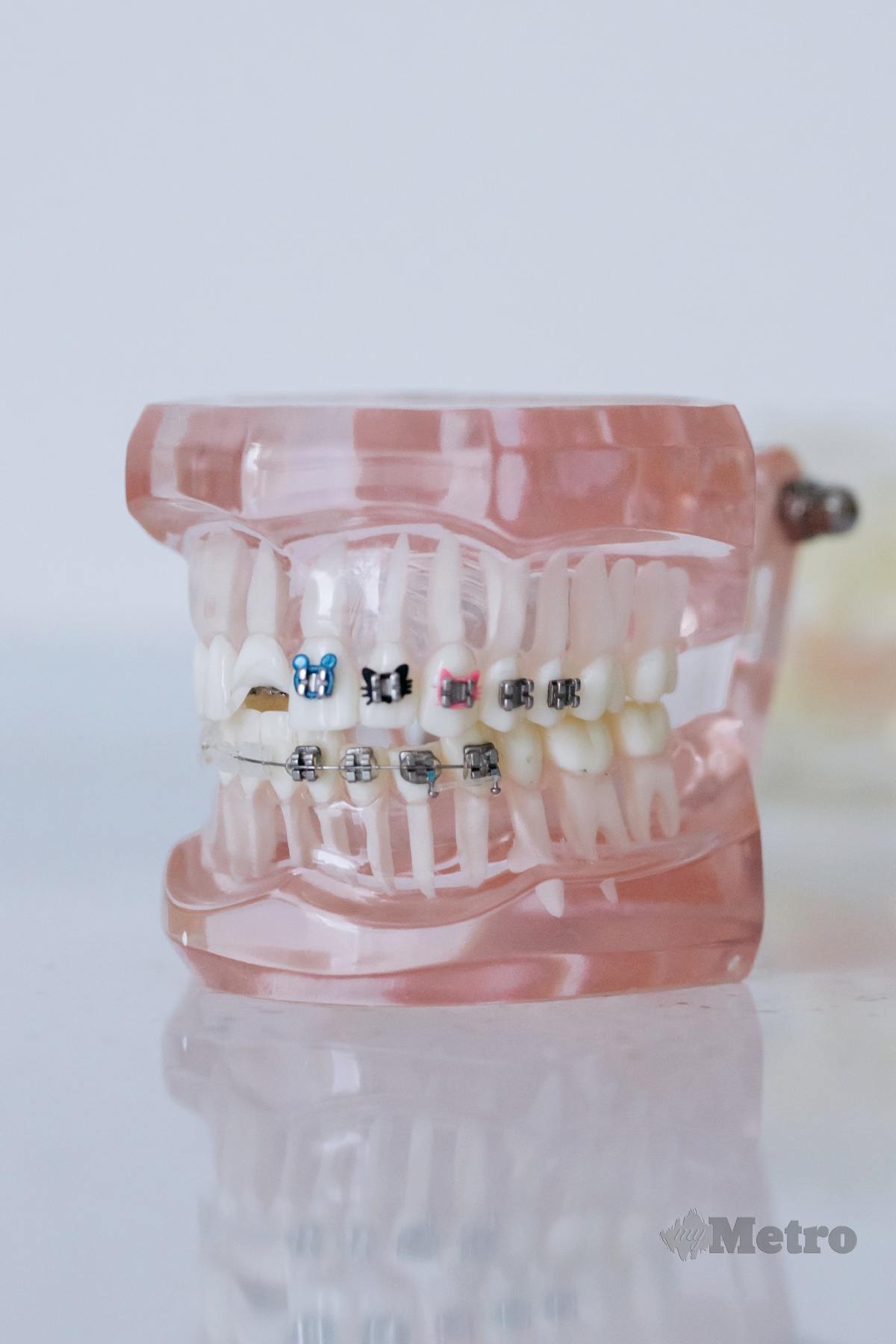PENDAKAP gigi biasanya dilekatkan pada permukaan gigi kekal.