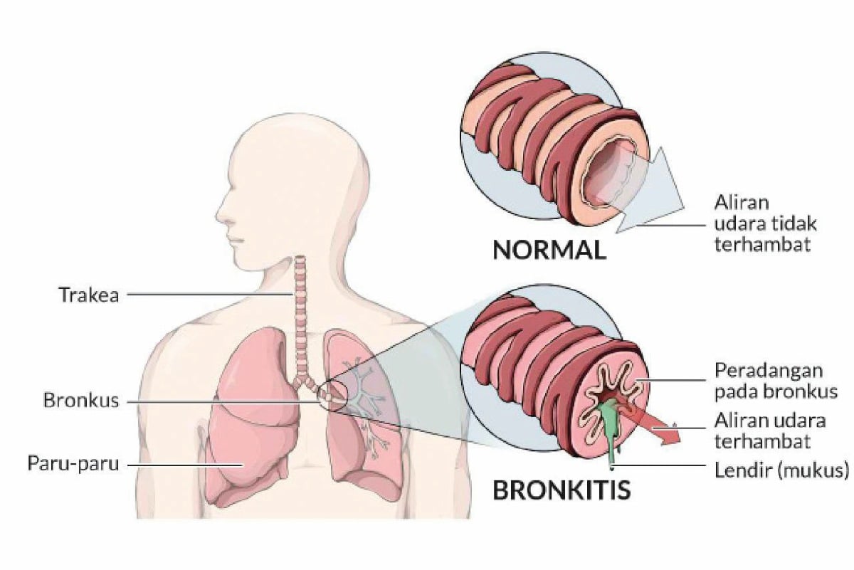 BRONKITIS berlaku apabila saluran yang dipanggil bronkiol yang membawa udara ke paru-paru mengalami keradangan dan membengkak. 