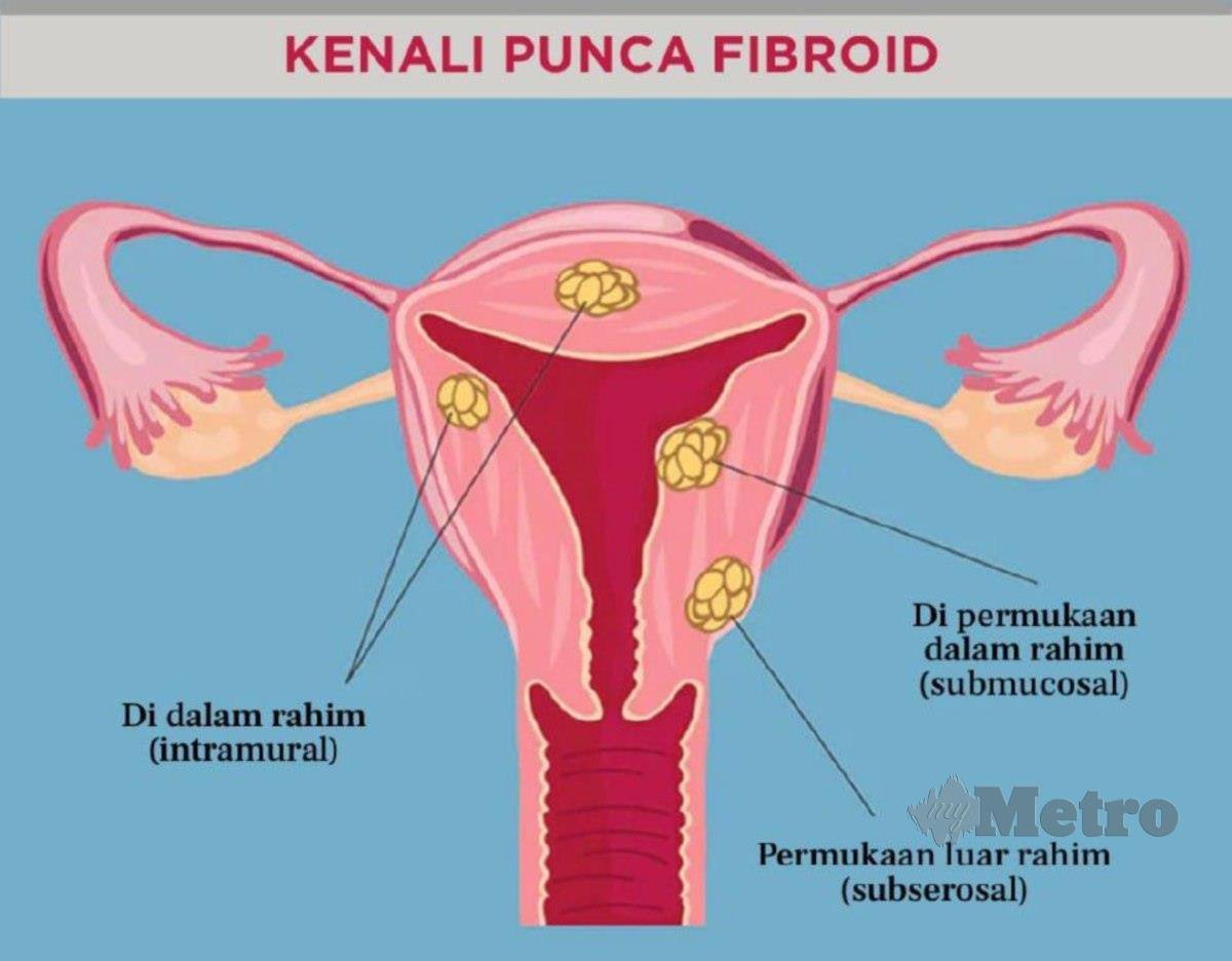 KETUMBUHAN benign (bukan kanser), fibroid sering berlaku pada wanita dalam usia reproduksi (subur). 