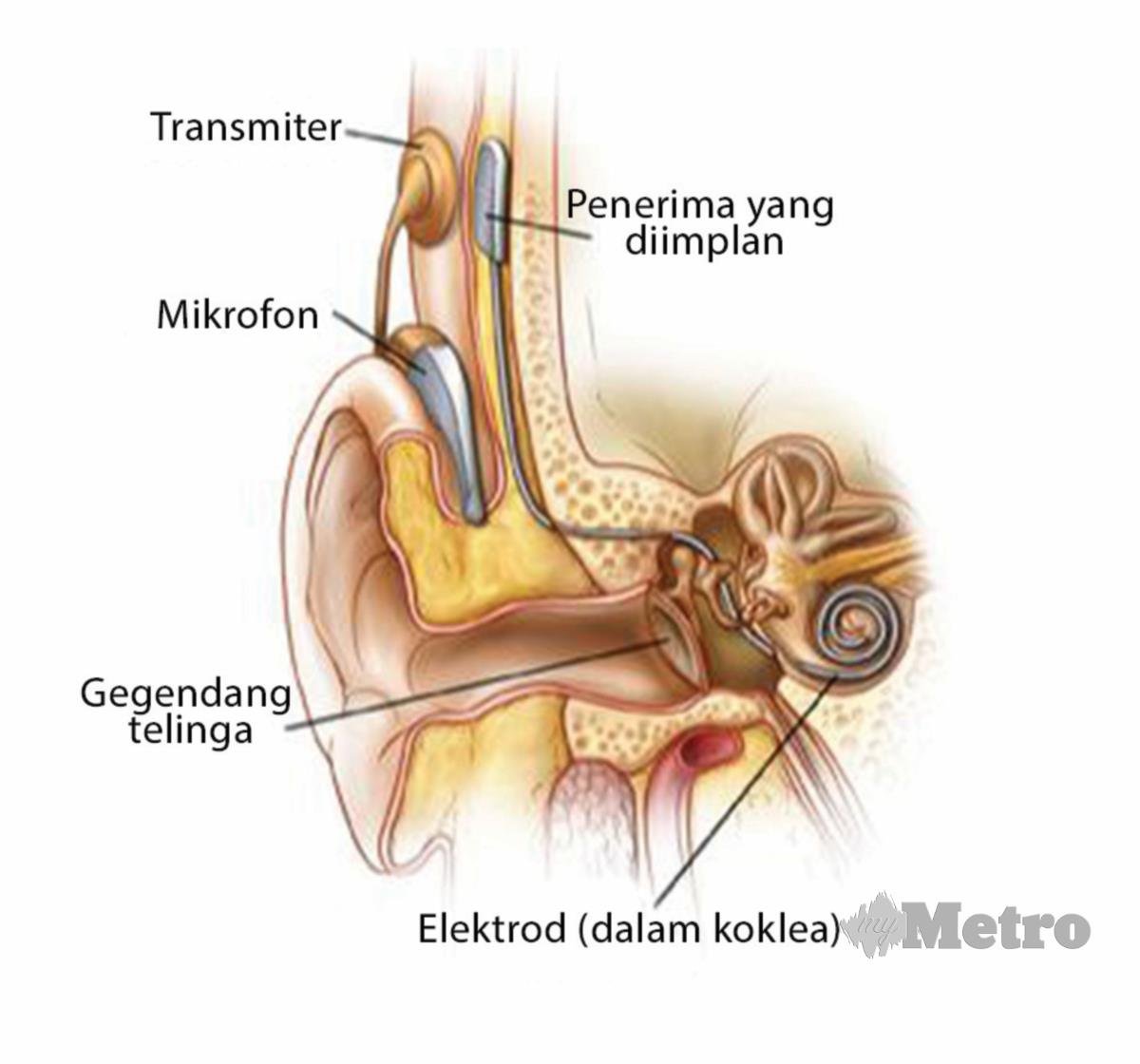 IMPLAN koklea membantu mengembalikan  pendengaran. 