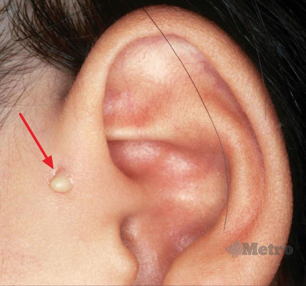 NANAH meleleh ke sinus (bukaan) pada telinga menunjukkan jangkitan.