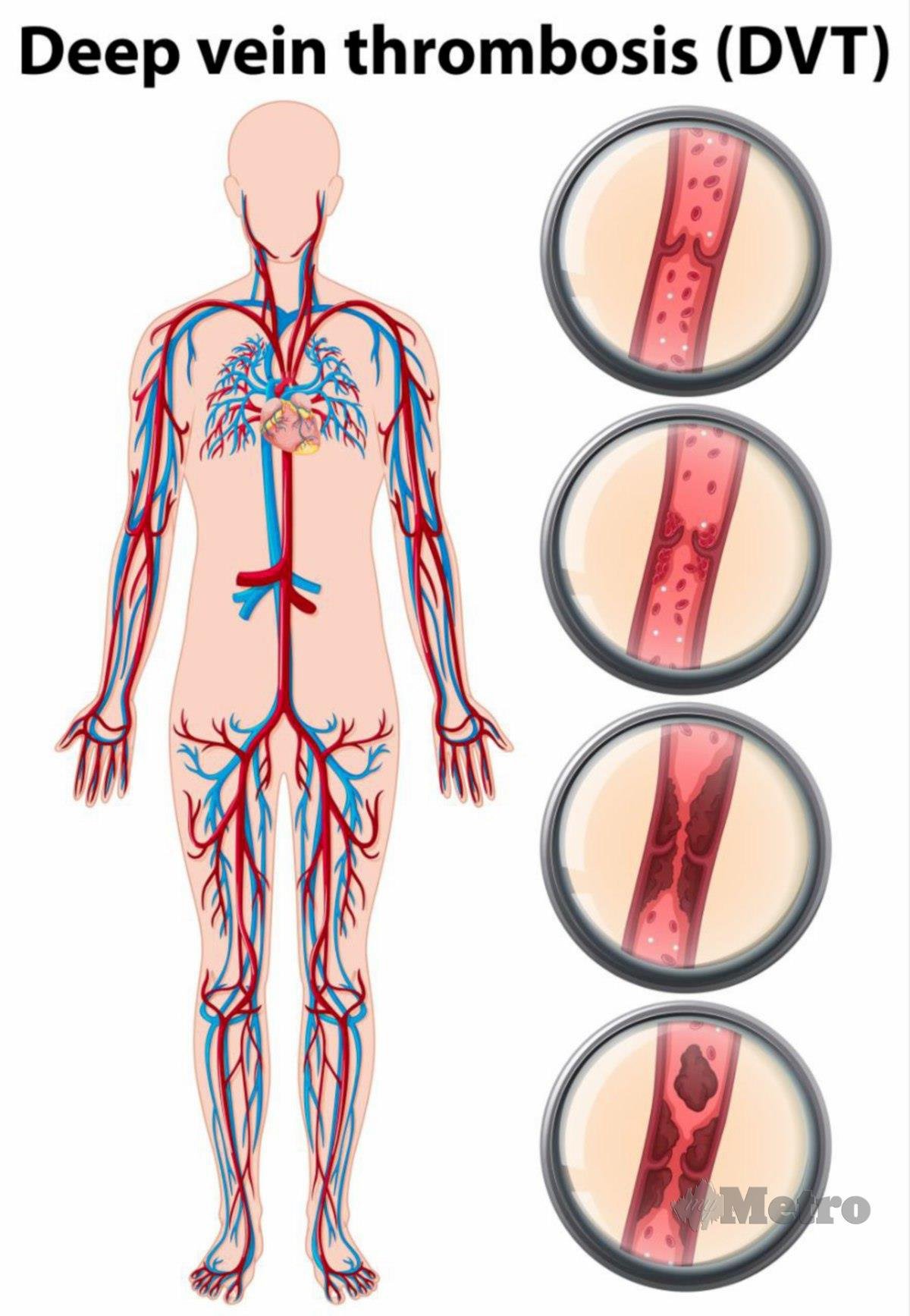 DVT berlaku apabila terdapat pembekuan darah terbentuk di dalam sistem vena dalam, biasanya di bahagian kaki.