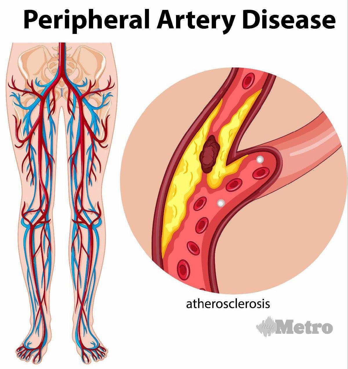ATEROSKLEROSIS adalah keadaan arteri menyempit dan mengeras akibat pengumpulan plak.