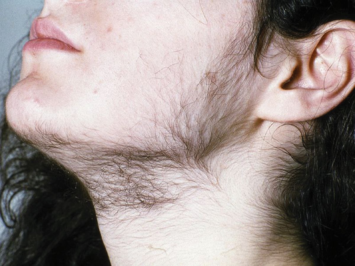 MASALAH rambut berlebihan yang biasa dialami oleh penghidap Sindrom PCOS. - FOTO Google