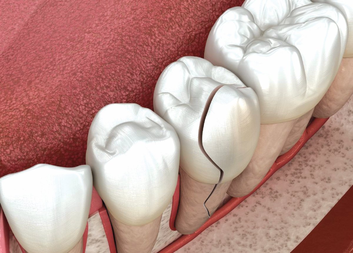 KEROSAKAN struktur gigi antara kesan mereka yang gemar mengunyah ais. - FOTO Google