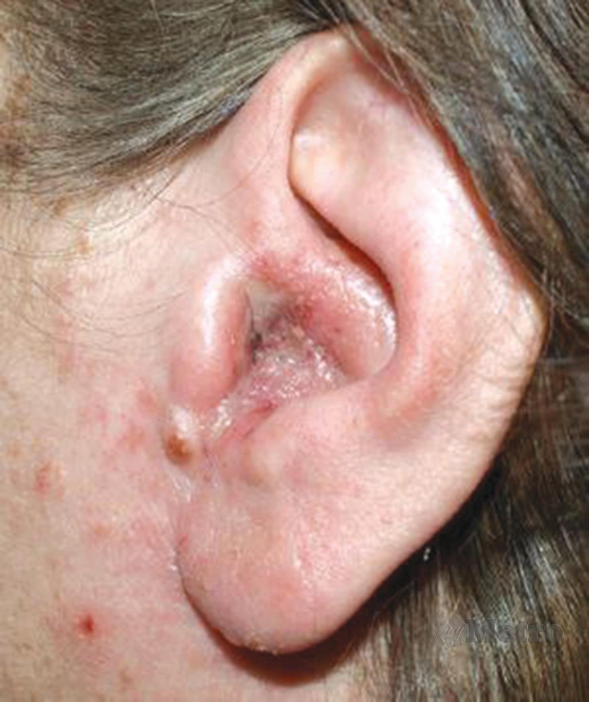 OTITIS luar akut antara masalah mungkin  dialami apabila kulit pada saluran telinga mengalami pendarahan sehingga membawa kepada jangkitan.